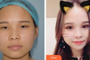 昆明華山眼科醫(yī)院汪志剛整形價格表附切開雙眼皮案例展示