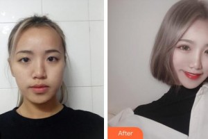 昆明華山眼科醫(yī)院徐慧整形價格表附切開雙眼皮案例展示