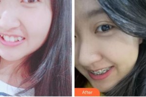 昆明醫(yī)科大學第二附屬醫(yī)院整形外科張景波整形價格表附齒隱形矯正案例展示