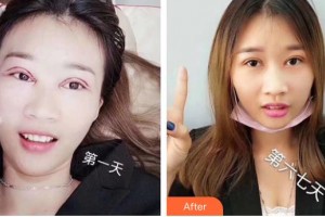 昆明醫(yī)科大學第二附屬醫(yī)院整形外科郭群整形價格表附切開雙眼皮案例展示