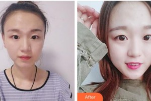 昆明愛爾眼科醫(yī)院徐彬整形價格表附切眉術例展示