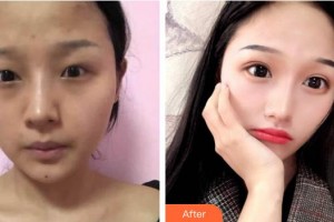 昆明華山眼科醫(yī)院袁天國(guó)整形價(jià)格表附切開雙眼皮案例展示