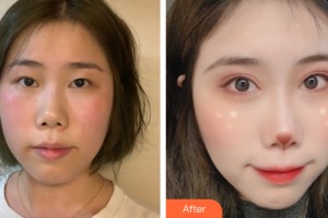 南寧市醫(yī)學美容診所曾衍整形價格表附雙眼皮手術案例展示