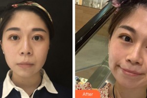 南寧華美整形美容醫(yī)院kevin整形價格表附皮膚美容案例展示