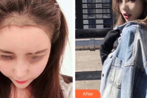 南寧悅星貞韓美容整形醫(yī)院郝帥整形價(jià)格表附植發(fā)案例展示