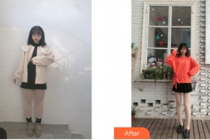 南寧賀爾美醫(yī)療美容門診部張永喆整形價格表附大腿吸脂案例展示