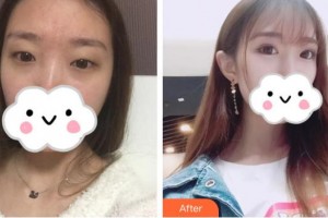 昆明愛爾眼科醫(yī)院程玉霞整形價格表附眼部綜合案例展示