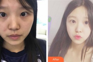 昆明普瑞眼科醫(yī)院宮樞政整形價格表附眼部綜合案例展示