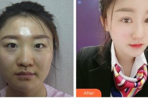 昆明普瑞眼科醫(yī)院袁援生整形價格表附定點雙眼皮案例展示