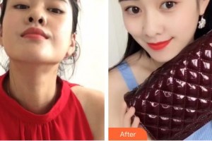 昆明愛爾眼科醫(yī)院董雪蓮住院醫(yī)師整形價格表附定點雙眼皮案例展示