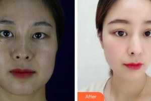 昆明普瑞眼科醫(yī)院秦秀芬整形價格表附上眼瞼去脂案例展示