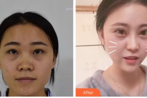 昆明普瑞眼科醫(yī)院邵彥明整形價格表附切開雙眼皮例展示