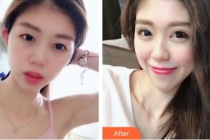 昆明普瑞眼科醫(yī)院趙青整形價格表附切開雙眼皮案例展示