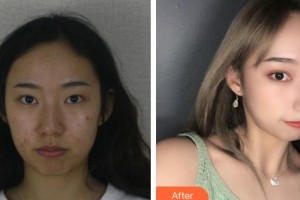 昆明普瑞眼科醫(yī)院雷鳴整形價格表附眼部綜合案例展示