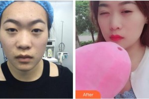 昆明普瑞眼科醫(yī)院何守科整形價格表附定點雙眼皮案例展示