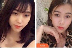 昆明愛爾眼科醫(yī)院楊朝舉整形價格表附眼部綜合案例展示