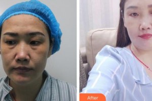 東南大學附屬中大醫(yī)院整形外科章慶國整形價格表附外切祛眼袋案例展示