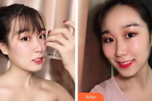 儲志強整形價格表附牙齒隱形矯正案例展示