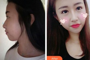 昆明愛(ài)爾眼科醫(yī)院管一沁整形價(jià)格表附眼部綜合案例展示