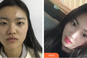 昆明阿瑪施眼科門(mén)診部翟國(guó)光整形價(jià)格表附切開(kāi)雙眼皮案例展示