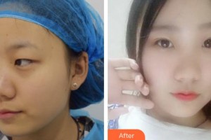 昆明阿瑪施眼科門診部姜耀和整形價格表附定點雙眼皮案例展示