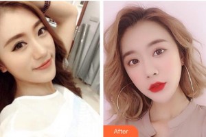 昆明愛爾眼科醫(yī)院瞿芳住院醫(yī)師整形價格表附開外眼角案例展示