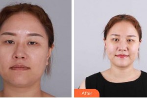 昆明普瑞眼科醫(yī)院楊槐整形價(jià)格表附眼部綜合案例展示