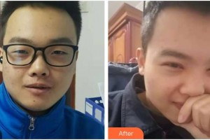 昆明眼科醫(yī)院字王雄整形價(jià)格表附開(kāi)內(nèi)眼角案例展示