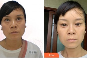 昆明阿瑪施眼科門診部李瑩整形價格表附激光去眼袋案例展示