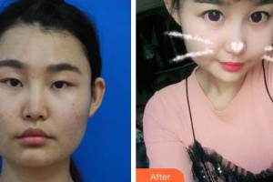 昆明眼科醫(yī)院段智寰整形價(jià)格表附切開(kāi)雙眼皮案例展示