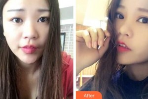 昆明愛(ài)爾眼科醫(yī)院張康林整形價(jià)格表附切開(kāi)雙眼皮案例展示