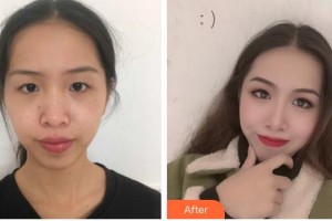 昆明康特森眼科醫(yī)院何彥明整形價(jià)格表附眼部綜合案例展示