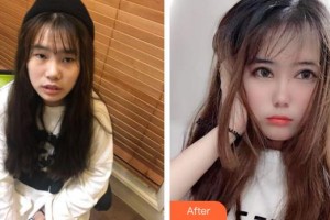 昆明康特森眼科醫(yī)院何玉清整形價(jià)格表附切開(kāi)雙眼皮案例展示