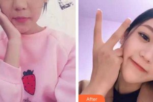 昆明眼科醫(yī)院馮雁整形價(jià)格表附定點(diǎn)雙眼皮案例展示