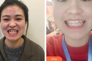 昆明拜博口腔醫(yī)院黃志堅整形價格表附牙齒矯正案例展示　