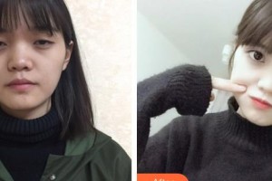 昆明眼科醫(yī)院袁俊彥整形價(jià)格表附開(kāi)內(nèi)眼角案例展示