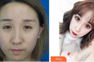 昆明阿瑪施眼科門(mén)診部王立東整形價(jià)格表附切開(kāi)雙眼皮案例展示