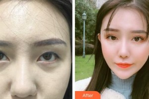 昆明普瑞眼科醫(yī)院羅燕珊整形價(jià)格表附眼部綜合案例展示