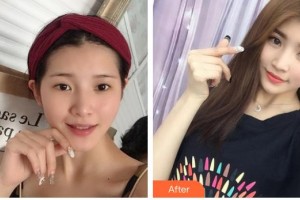 昆明普瑞眼科醫(yī)院梁東生整形價(jià)格表附切開(kāi)雙眼皮案例展示