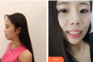 昆明拜博口腔醫(yī)院何繡君整形價(jià)格表附牙齒隱形矯正案例展示