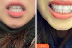 昆明拜博口腔醫(yī)院高建乙整形價(jià)格表附隱形托槽矯正案例展示