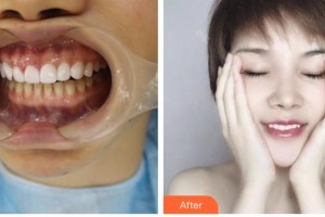 昆明拜博口腔醫(yī)院王爽整形價格表附美白貼片案例展示