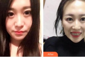 昆明拜博口腔醫(yī)院孫婷婷整形價格表附金屬托槽矯正案例展示