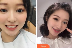 昆明拜博口腔醫(yī)院陳情整形價格表附金屬托槽矯正案例展示