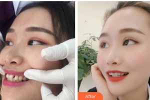 昆明拜博口腔醫(yī)院張馨月整形價格表附隱形托槽矯正例展示