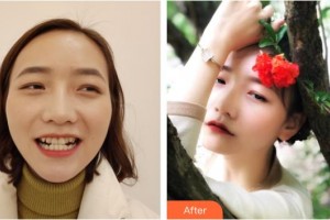 昆明拜博口腔醫(yī)院湯惟惟整形價格表附牙齒隱形矯正案例展示