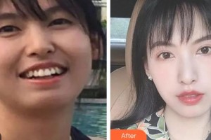 昆明拜博口腔醫(yī)院施琳玲整形價格表附金屬托槽矯正案例展示