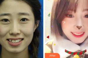 整形醫(yī)院童曉昕整形價格表附牙齒隱形矯正案例展示