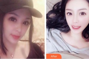 昆明吳氏嘉美美容醫(yī)院楊正梅整形價格表附金屬托槽矯正案例展示