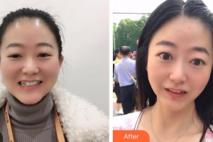 昆明尚愛韓美口腔門診部胡安然整形價格表附牙齒隱形矯正案例展示